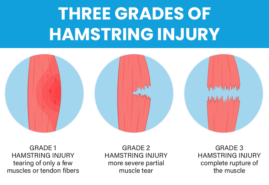 three grades hamstring injuries soccer strain prevention